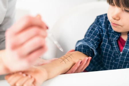 Allergen-Immuntherapie 2021 – was ist neu?  AIT in der Pandemie, AIT bei Kindern, Hausstaubmilbenallergie
