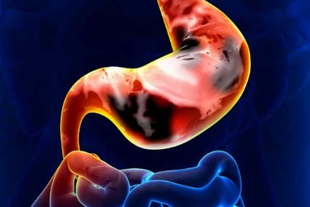 Reserve- oder nicht Reserve-Antibiotikum? Neue Optionen in der Behandlung von MRGN bei intraabdominellen Infektionen