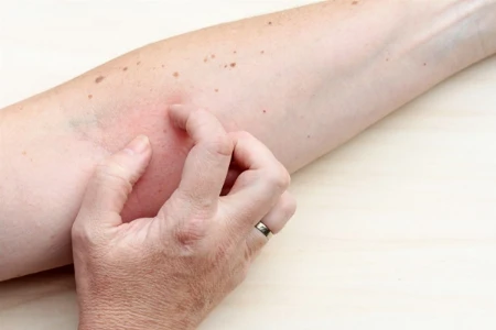 Aktualisierung der evidenz- und konsensbasierten S3-Leitlinie zur atopischen Dermatitis: Systemtherapie Biologika, Schwangrschaft, Stillzeit