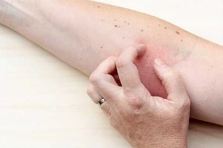 Atopische Dermatitis und psychosoziale Komorbiditäten – Was gibt es Neues?