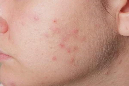 Atopische Dermatitis: Von der Diagnose zur Therapie