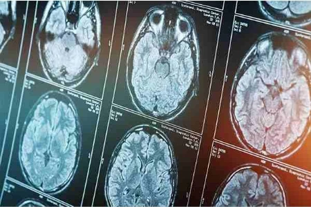 Idiopathisches Parkinson-Syndrom – Neue Aspekte zu Ätiologie und Pathophysiologie