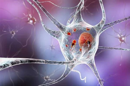 Parkinson und Bewegungsstörungen – Neues aus der Neuroimmunologie
